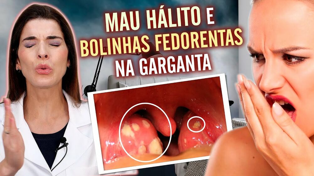 Bolinhas brancas na garganta: por que causam mau hálito?