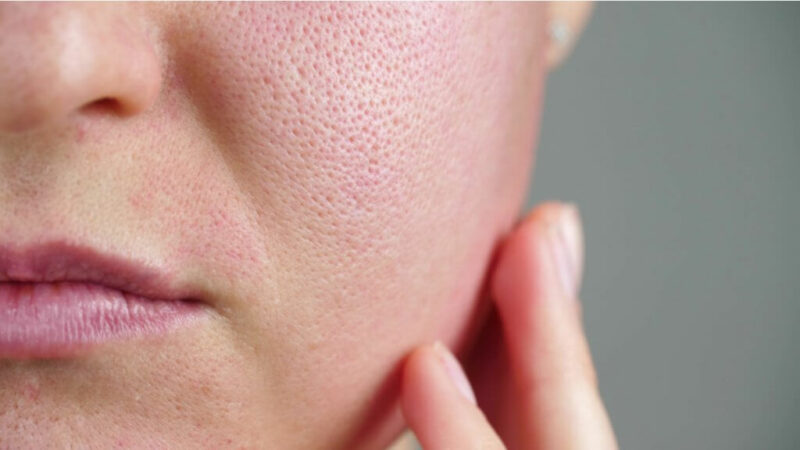Passo a passo para reduzir os poros dilatados: veja dica de tratamento caseiro